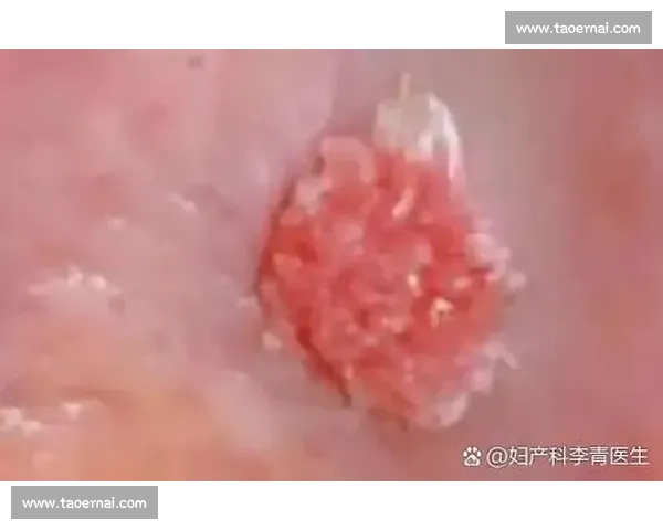 尖锐湿疣的传播途径防治方法及其对身心健康的影响分析